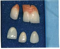 Figure 3. Preoperative view with existing root form implants. Figure 4. Severe root exposure of tooth No. 6. Figure 5. Tooth No.