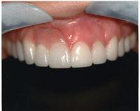 7 and 8. Figure 7. Teeth Nos. 6 to 8: porcelain-to-gold crowns. Teeth Nos. 9 and 11: porcelain laminate veneers. Tooth No.