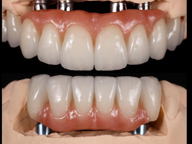 Creator #5 AKI OGATA Atelier Ogata Achieving Esthetic Results with Complex Implant Restoration We encounter various situations in everyday clinical practice.