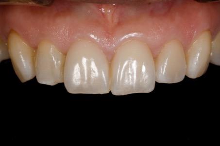 of stain, and detailed staining procedure. Naoto Yuasa, RDT, graduated in Tokyo, Japan Toho Dental Technician School in 2004.