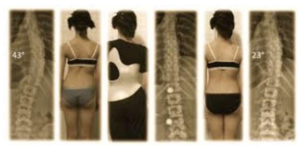 Conclusions and Recommendations Level of Evidence I for PSSE and bracing for scoliosis