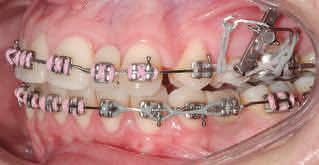 On the mandibular arch, an implant was inserted into the space of the missing premolar to aid mandibular midline correction.