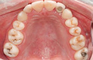 malocclusion with