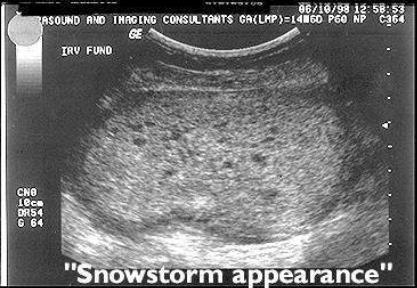 Large for date; which means that the baby appears as 12 weeks old under the ultrasound, but he is actually 6 weeks (according to the mothers calculations) mostly occurs before 20 and after 40 yr of