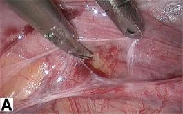 SUTURE OF OVARIAN