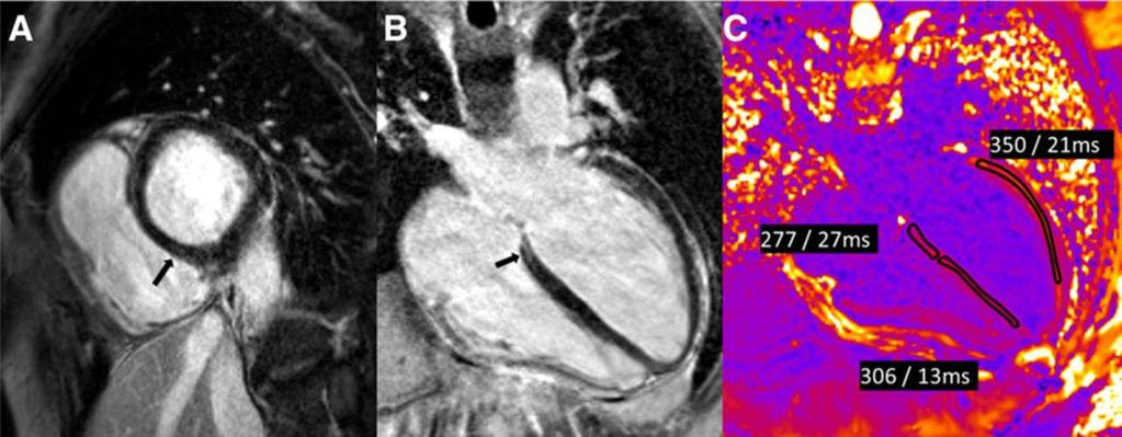 Delayed enhancement imaging in the same patient as in Figure 3, illustrating a focal area of midmyocardial enhancement (arrows) involving the basal inferior septum seen in both