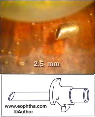 When the 23 gauge system is used, the trocar keeps the port open, and intruments are repeatedly introduced directly into the vitreous cavity.