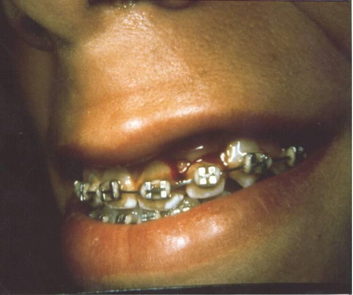 22 Although the teeth are splinted with braces, the soft tissues could