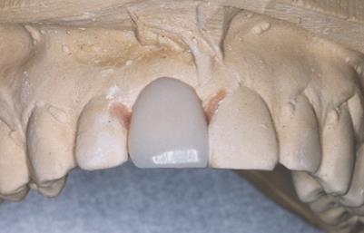 92 Artificial tooth is shaped
