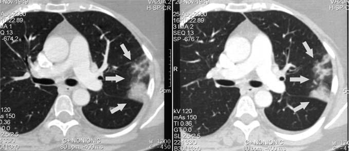 Pulmonary arterial hypertension is rare and can be documented only in patients with multi-vessel involvement Fig. 2.
