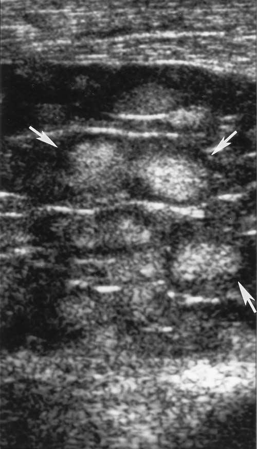 J Ultrasound Med 18:513 517, 1999 LIN ET AL 515 Figure 4 Longitudinal sonogram of the left elbow medially, distal to the cubital tunnel, reveals a solitary ovoid mass (arrows), with a tapered