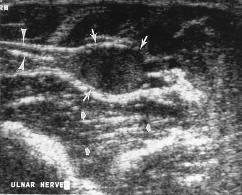 Figure 3 Small field of view longitudinal sonogram of the posterior right thigh shows numerous conglomerate lobulated masses, each demonstrating the target sign (arrows) appearance.