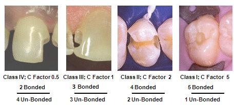 Figure 1 As the number of bonded surfaces increase relative to unbonded surfaces, the C-factor increases. (Clinical pictures courtesy of Dr.