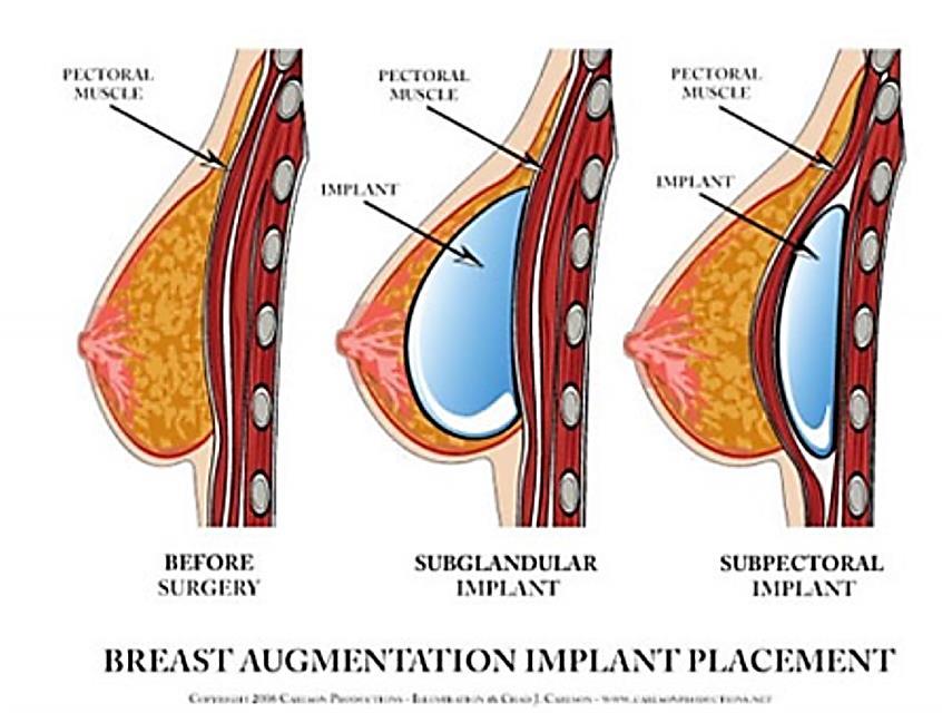 Mastectomy can result in very thin skin that provides inadequate coverage for an Submuscular placement become the standard of care Advantages -Behind the pectoralis muscle reduces visibility,