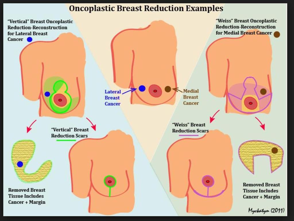 (https://westcountyplasticsurgeons.wustl.edu/surgery/breast-surgery/breastreconstruction/reconstruction-for-lumpectomy.