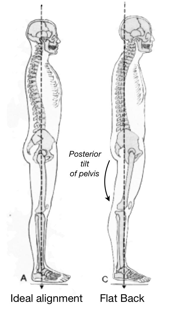 Tight and inflexible hamstring muscles have a profound impact on our posture. When the hamstrings are tight, it causes the pelvis to tuck into a posterior tilt position.