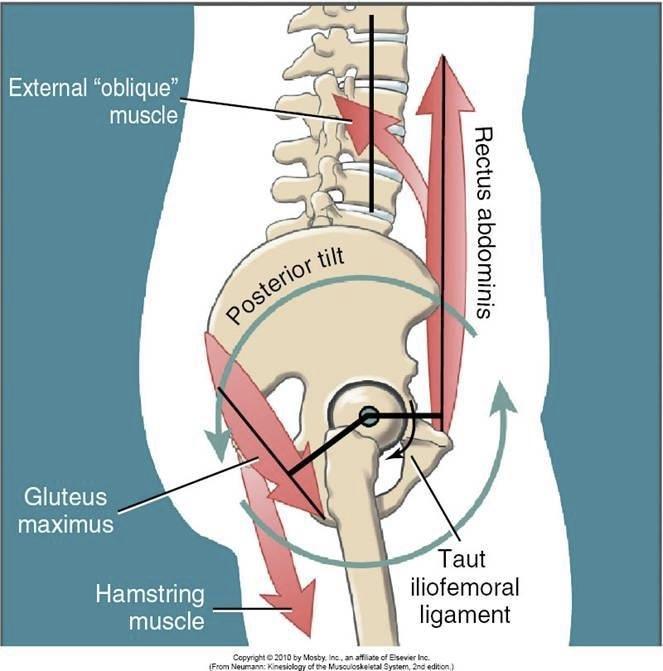This postural alignment caused by tight hamstrings is referred to as flat back postural alignment.