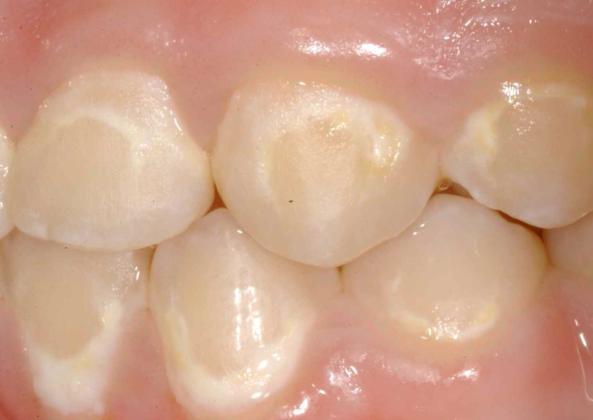 Casein phosphopeptides (CPP) are products of milk protein casein and are thought to have the ability to increase the level of calcium phosphate in dental plaque, depressing the demineralization
