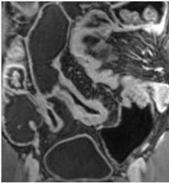 Imaging A 30-cm-long segment of ileum adjacent to the cecum is narrowed with marked thickening of the ileal wall, ulcerations and hyper-enhancement on the T2 weighted image. The lumen is narrowed.