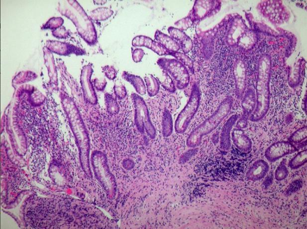 Histology Deep ulcerations present in the mucosa and submucosa. Dense inflammatory infiltrate consisting of chronic inflammatory cells in the mucosa and submucosa. No granuloma seen.