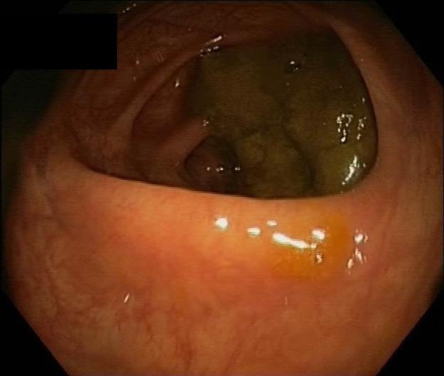 Colonoscopy shows active inflammation up to 45 cm above the anal margin.