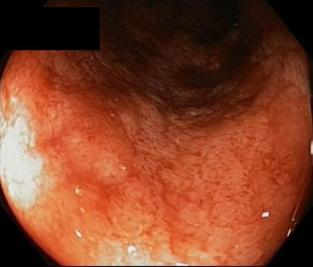 no large or deep ulcers. A series of inflammatory pseudopolyps is also present in the sigmoid.
