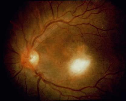 Ocular Toxoplasmosis retinochoroiditis: likely due to both active parasite