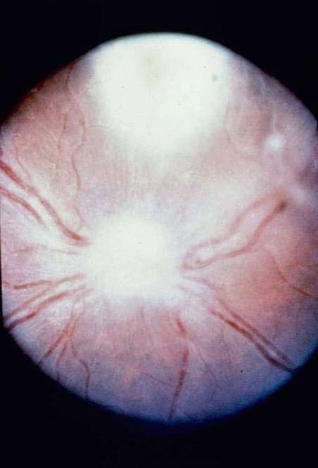 Ocular Toxoplasmosis retinochoroiditis: likely due to both active parasite proliferation and immune hypersensitivity generally a recrudescence-- rarely from primary