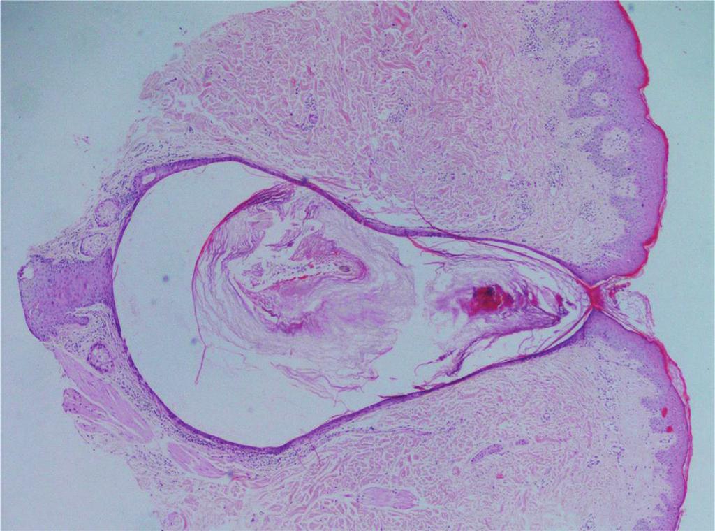 Severe desquamation of follicle epithelia and sebaceous gland epithelia also plays a role in pathogenesis.