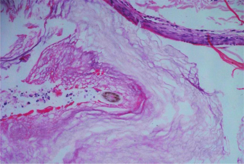 These tiny cysts may consist of cornified cells, hair shafts, sebum, P. acnes, and other bacteria. Closed comedones orifices on epidermis can be normal in size, mild wider, or narrower (Figures 9 11).