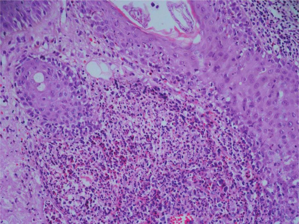 142 Acne and Acneiform Eruptions Figure 2. In a bacterial folliculitis case, predominantly neutrophilic infiltrate is present in the upper dermis and invades the follicular epithelia (HE 100).