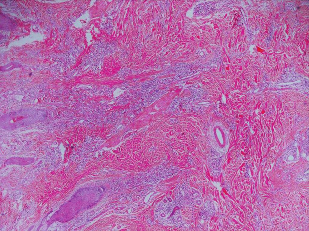 146 Acne and Acneiform Eruptions Figure 5. Fibrosis in the dermis which can turn into a hypertrophic scar (clinically an acne keloidalis nuchae case) (HE 100).