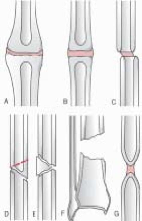 tibial correction. Commonly use locked plate fixation or intramedullary nailing for distal or proximal diametaphyseal malunion fixation and tibial nailing for diaphyseal malunion.
