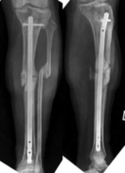 4 months, and the average time for a fracture to be labelled a nonunion was 6.3 +/ 2.1 months. Weber s Types: A. Elephant's foot. B. Horse's foot. C. Oligotrophic. D.
