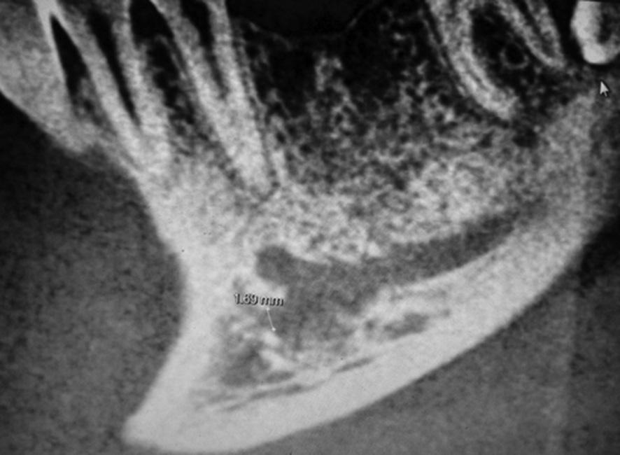 Figure 1: Anterior loop of mental foramen on the left side Figure 4: Reveals anterior loop of mental foramen