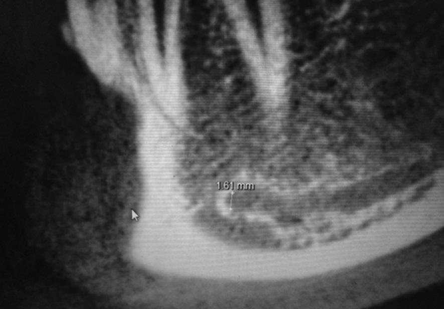 80%) patients had anterior loop of mental foramen which was present unilaterally (left or right side) in 24