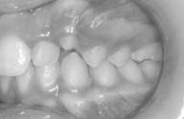 MOLAR DISTALISATION WITH SKELETAL ANCHORAGE Figure 2. Case 1. Pretreatment intra-oral views of the mild Class II malocclusion in a 12 year-old girl. years of age.