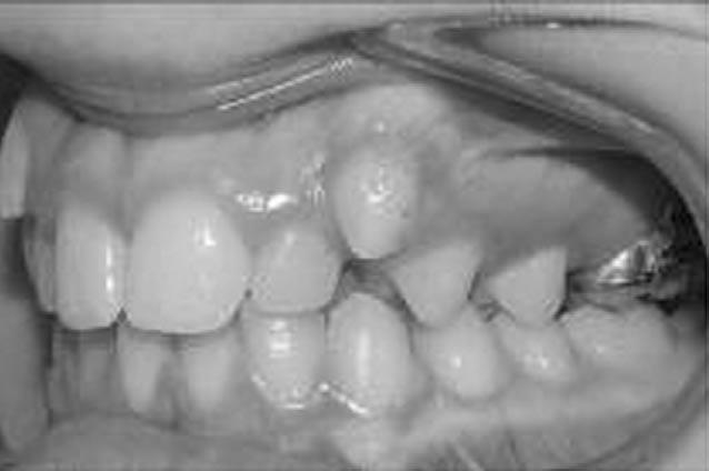 GRACCO ET AL Figure 3. Case 1. Molar distalisation with the initial design and spontaneous distal movement of the upper second premolars. Figure 4. Case 1. Pre- and post-distalisation tracings superimposed on maxilla.