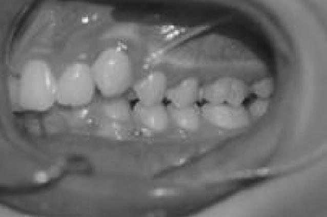 MOLAR DISTALISATION WITH