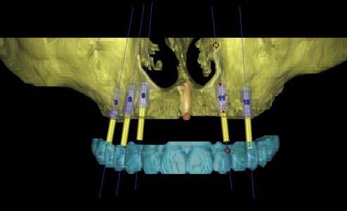 CT scan analysis for presurgical planning Planned tooth position Patients native bone Cross section view of one the 5 implant positions.