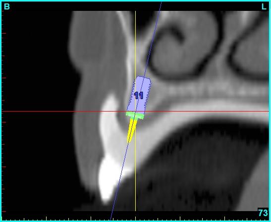 Nerve identified Virtual (3D) CT scan implant planning Three dimensional reconstruction demonstrating planned implant positioning for this patient. 5 Implants will be placed.