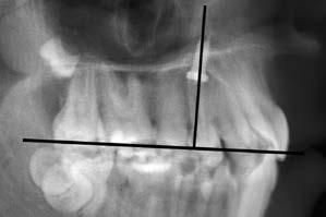 The area immediately posterior to the palatal rugae, referred to here as the T-Zone, is a more suitable region for insertion of palatal miniimplants due to the available bone volume (Fig. 1).