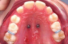 As a general rule, mini-implants should not be inserted directly into the anterior area of the palatal rugae, but posterior to the third palatal rugae within the T-Zone.