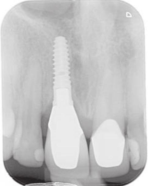³ Pre-op Digital Workflow for Implants A CT scan can provide accurate 3D imagery to aid planning for an implant-supported restoration and reveals the precise location of a root within the alveolus
