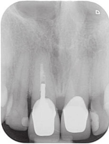 The proposed implant with an abutment projection can then be positioned to emerge through the desired restorative result, linking the implant to the envelope of the tooth.