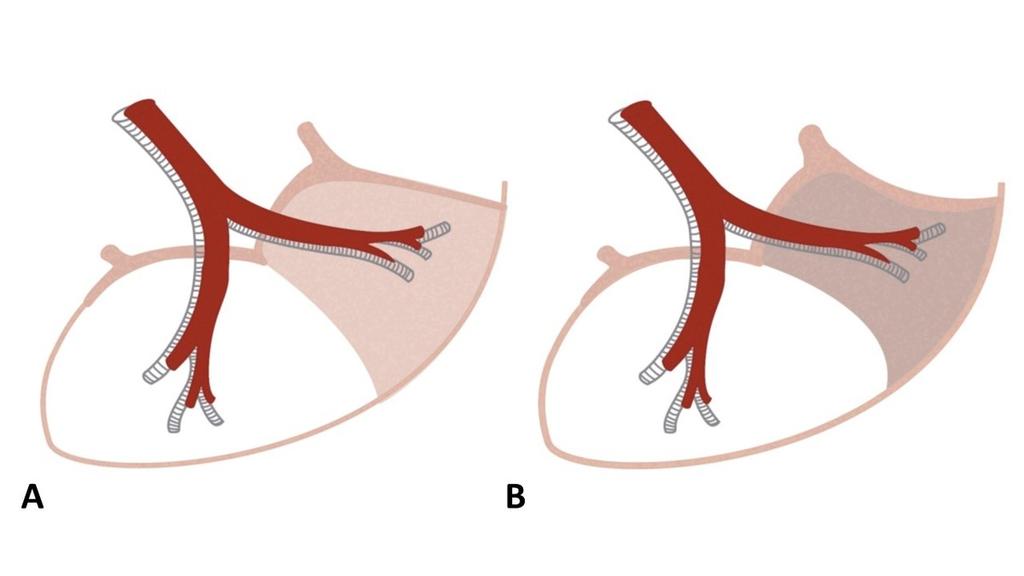 Fig. 5: Drawing of bronchiolectasis with a broncoarterial ratio that exceeds one (signet ring sign) and absence of normal bronchiolar tapering. Rivera A.L. 2017.