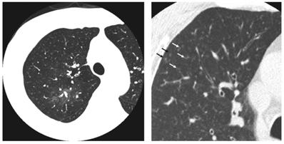SMALL AIRWAY DISEASE IN ASTHMA 3 Fig. 1 High-resolution computed tomography of 0.5 mm collimation on asthma exacerbation.