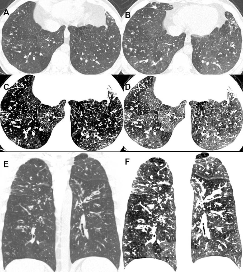 Fig. 3: A and B inspiratory and expiratory images (window width 1500, window level -700 HU) at the lower lung zone show mosaic attenuation pattern with multiple bilateral lobular air trapping.