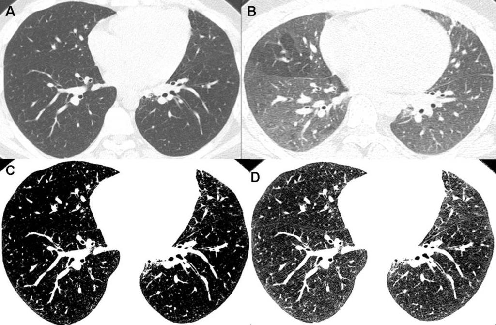 Fig. 4: A and B inspiratory and expiratory images (window width 1500, window level -700 HU) at the lower lung zone show focal area of air trapping at the right middle lobe.