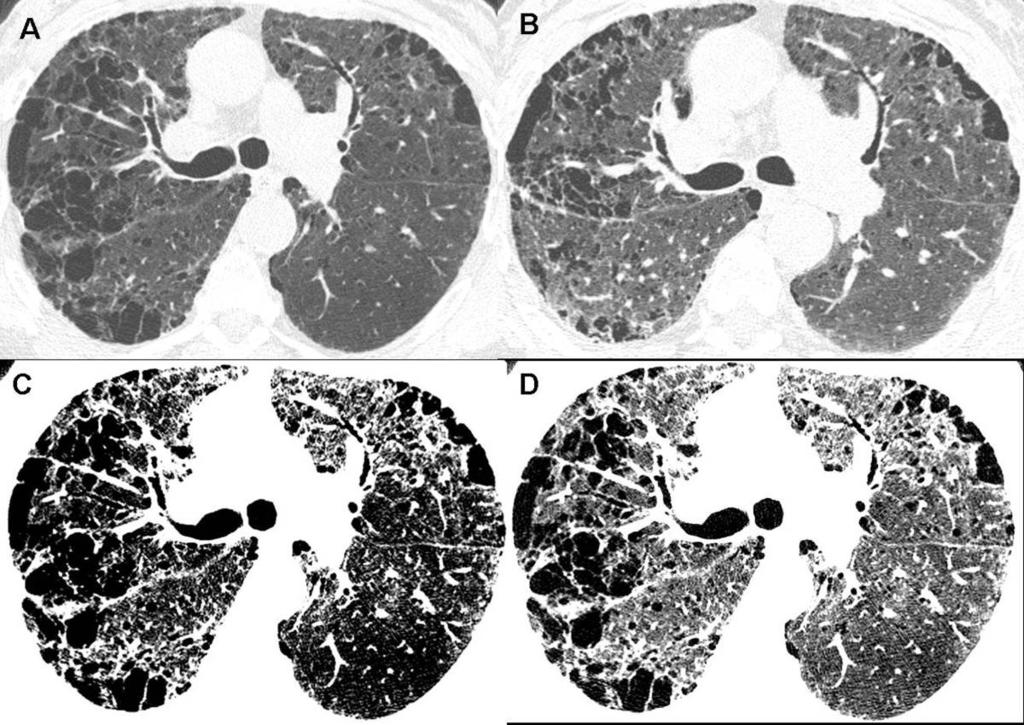 Fig. 5: A and B inspiratory and expiratory images (window width 1500, window level -700 HU) at below the carina level show right more than left paraseptal emphysema without air trapping.
